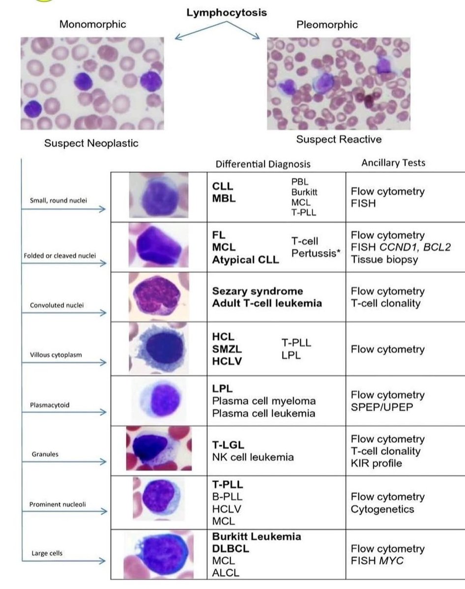 A detailed differential diagnosis chart for lymphocytosis.

It categorizes lymphocytes based on their morphology in a blood smear into monomorphic (suspect neoplastic, or malignant) and pleomorphic (suspect reactive, usually due to infection or inflammation) types.