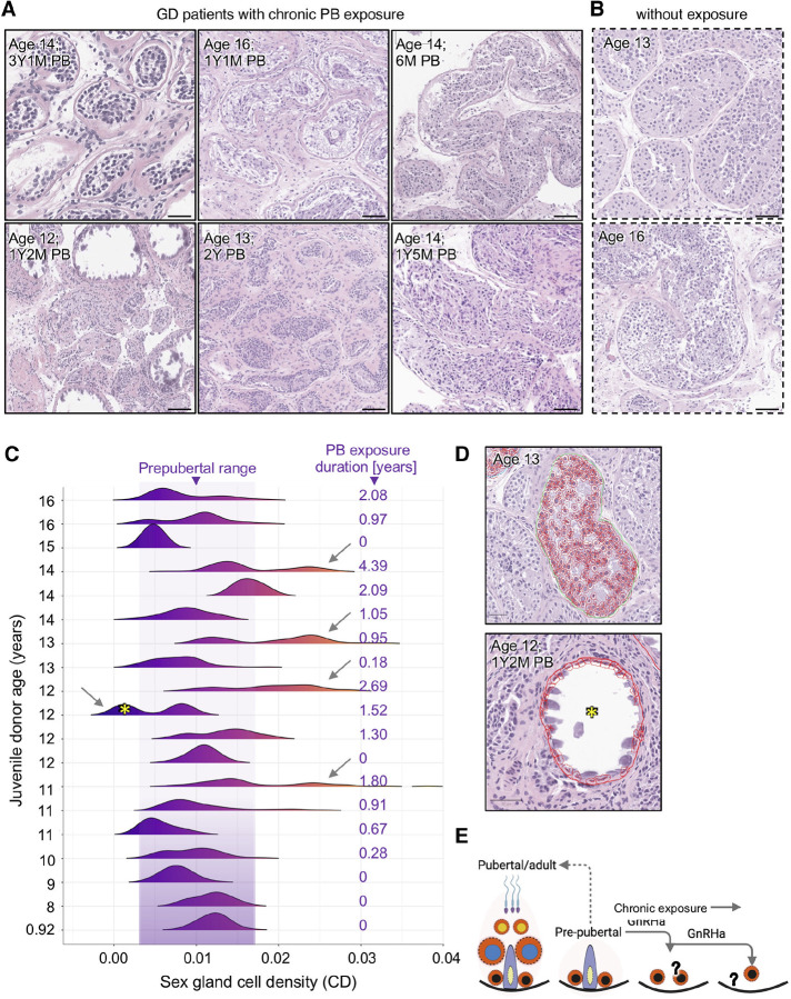 A histological analysis of testicular tissue taken from boys receiving puberty blockers for gender dysphoria showed that the tissue had abnormal development that was likely to be irreversible.
statsforgender.org/boys-receiving…
