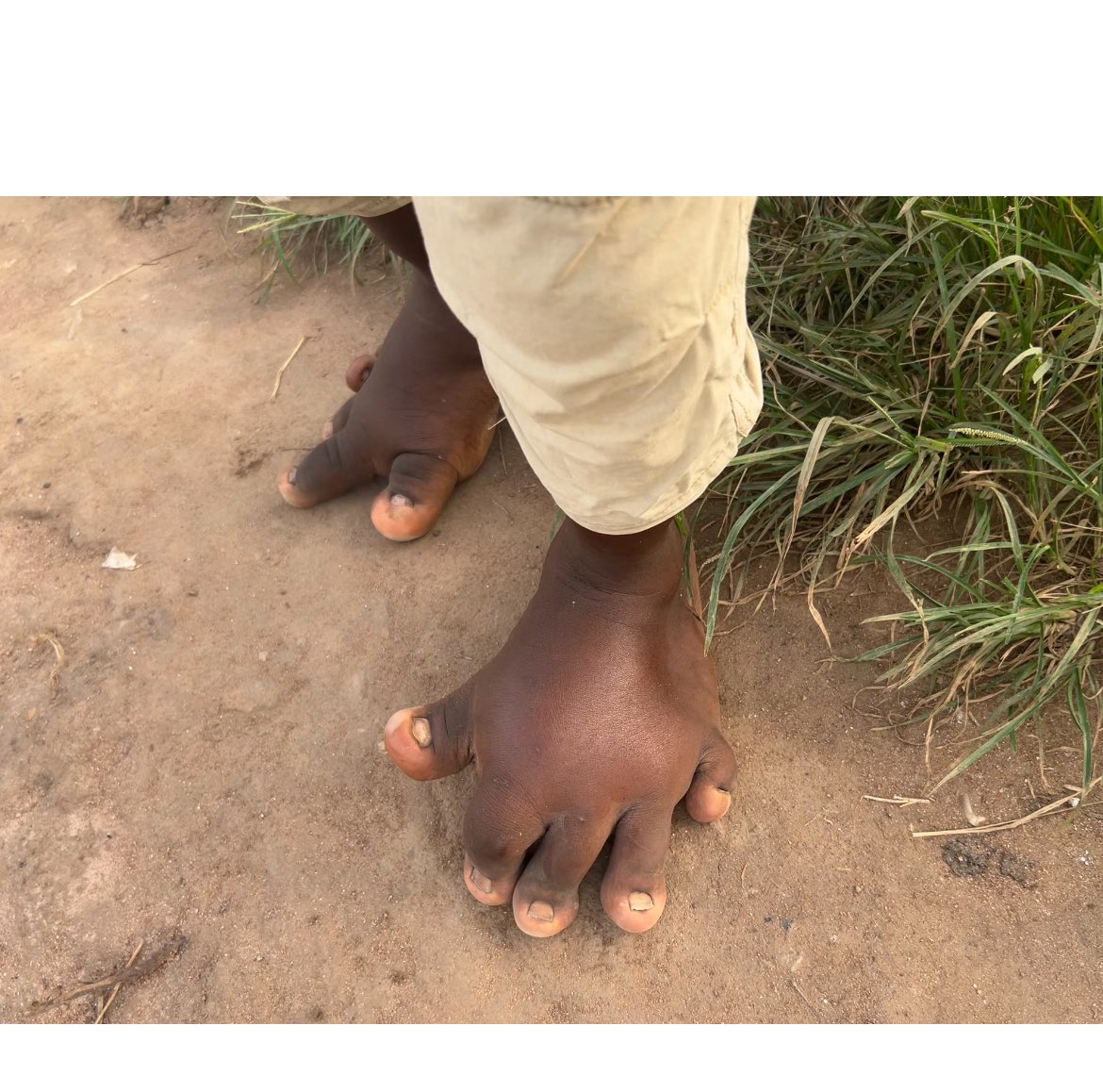 Please if anyone or someone can help this boy! Known this boy for 5years and it’s getting bigger everyday! <a href="/aproko_doctor/">Dr. Chinonso Egemba</a> <a href="/Dr_Pharouk/">Dr Farouk</a> <a href="/Wizarab10/">Sir Dickson</a>