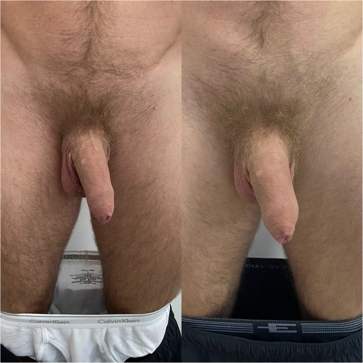 Menplusmadrid's tweet photo. Engrosamiento de pene con infiltración médica de 15 ml de ácido hialurónico. Personalizado y confidencial. Sin cirugía agresiva. Primera valoración sin compromiso. En Madrid, funciona.

MENPLUS MADRID

#AcidoHialuronico #EngrosamientoDePene #EsteticaMasculina #Madrid https://t.co/J6rFRIq9NJ