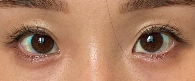 TOBE美容外科でオペ3ヶ月後レポ✨

他の用事で病院に行ってもどの先生にもすごく綺麗にオペしてもらってるねと毎度言われます👍
なので、お願いしてよかったー！とめっちゃ思っております🐱

#TOBE美容外科