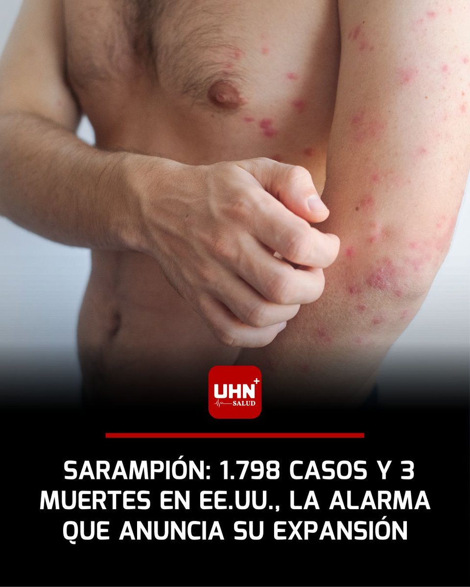 🩺‼️ | Estados Unidos registra ya 1.798 casos confirmados de sarampión en 42 estados, con tres muertes trágicas incluyendo dos niñas en Texas, impulsados por una caída alarmante en las tasas de vacunación infantil que ha bajado en el 77% de los condados desde 2019, según el CDC y