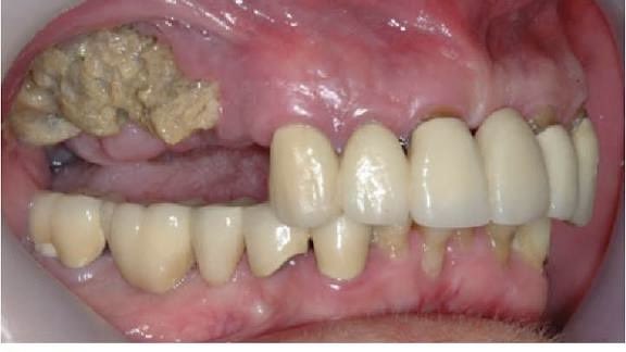 IlliasulK's tweet image. What is this? Who’s the culprit?
And what’s the mechanism behind this drug-induced finding? 

Drop your answers in the comments &amp;amp; repost to test your friends!

#MedTwitter #RheumTwitter #DermTwitter #DrugReactions #ClinicalPearls #SpotDiagnosis #Tweetorial @DrAkhilX
