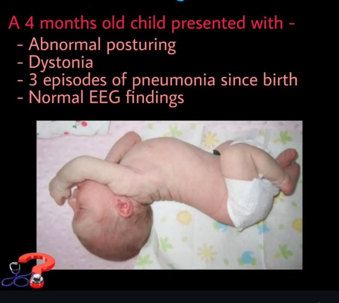 A 4 months old child presented with -
- Abnormal posturing
- Dystonia
- 3 episodes of pneumonia since birth
- Normal EEG findings
What’s your diagnosis??