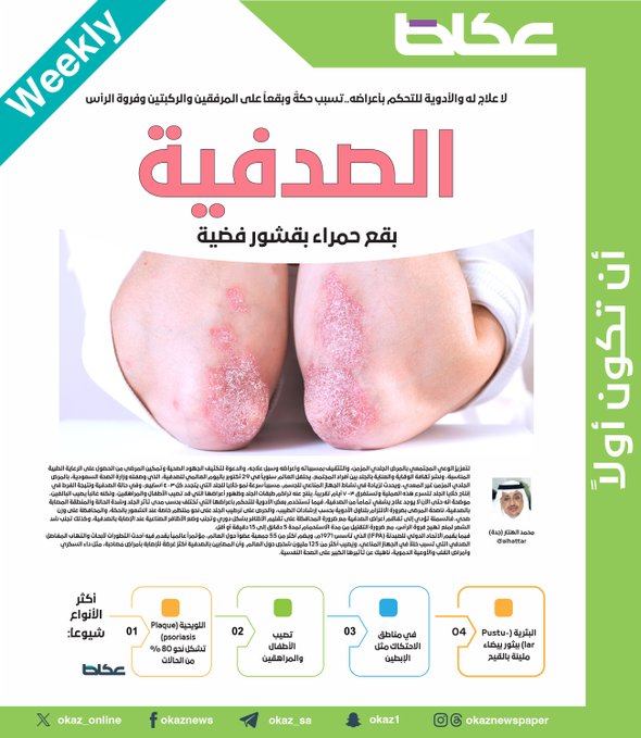 لا علاج له والأدوية للتحكم بأعراضه..تسبب حكةً وبقعاً على المرفقين والركبتين وفروة الرأس... الصدفية بقع حمراء بقشور فضية. محمد الهتار. للاطلاع على 