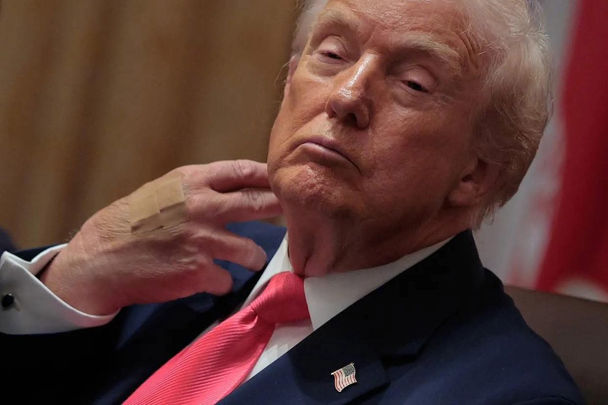 Donald Trump may be receiving the Alzheimer’s drug Leqembi. 

It is administered via IV in the hand, causes swelling in the brain requiring regular MRIs, and one of the main side effects is tiredness.
The bandaged hand occurs monthly which corresponds to monthly Leqembi injection