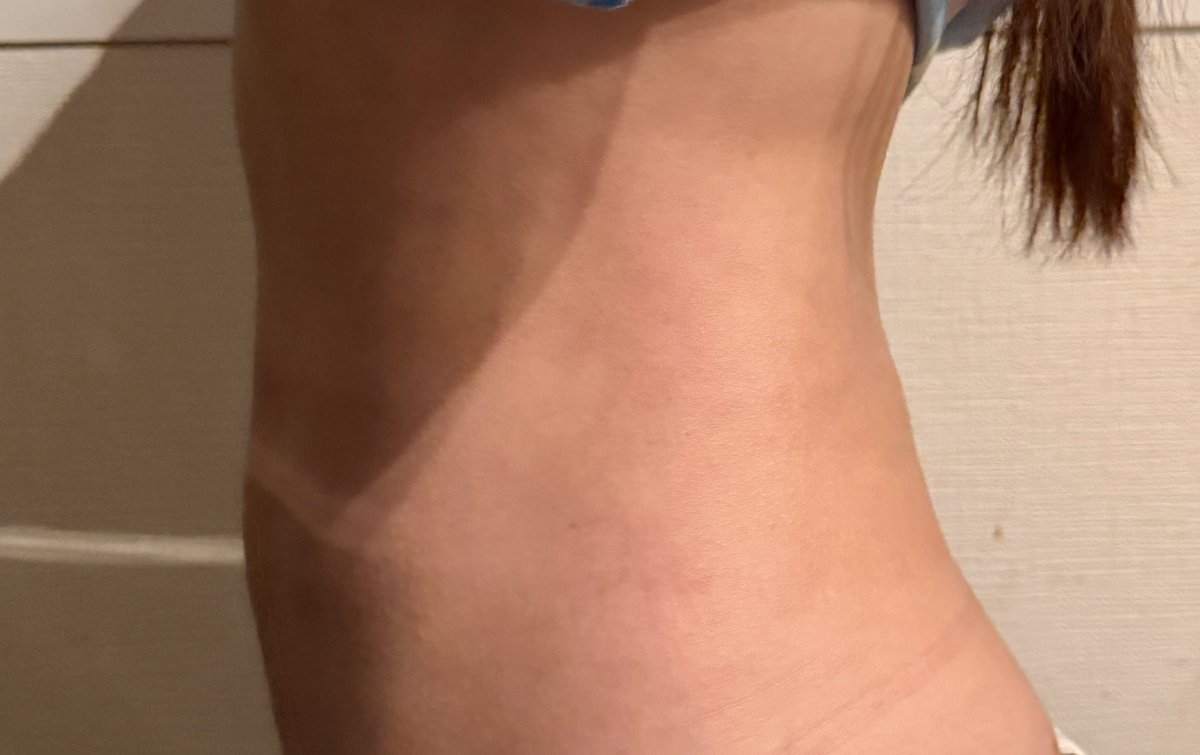 lardo0101's tweet photo. #ディライト美容外科　で腹部脂肪吸引を受けて4ヶ月経過！
実は体重が増えたんだけど、お腹周りは変わってなくて油断している🤣
筋トレもしてるから、写真よりも実物の方がスッキリしてるよ　@delight_ps_jp https://t.co/WfgATPYctD