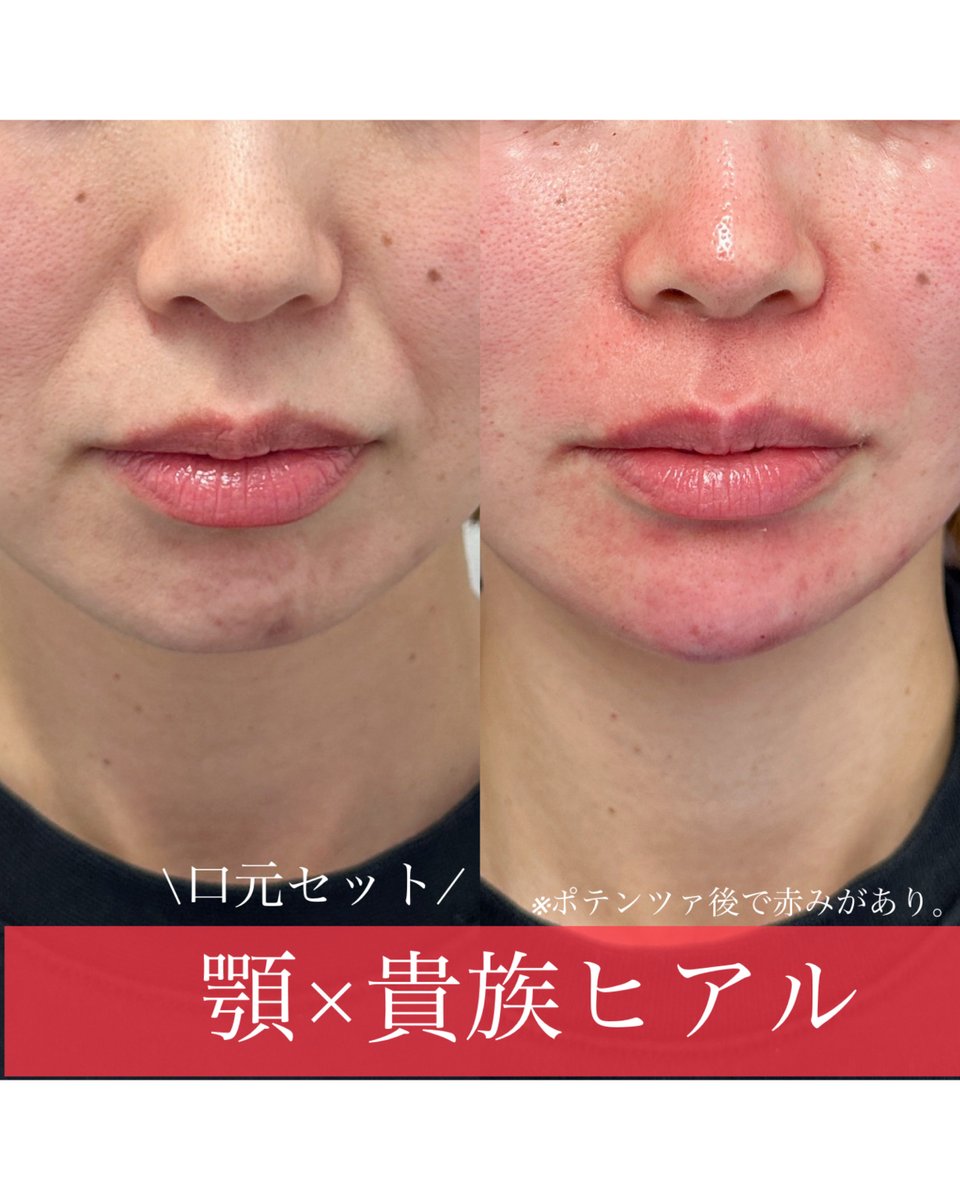 dr_yokose's tweet photo. #ルラ美容クリニック 
#ルラ美容クリニック郡山院

境目にこだわるのは
ヒアルロン酸も同じ。

アフターだけを見て、どこに入ってるかわからない…

と言われるようなヒアル注入を心がけています。 https://t.co/lRIOIodDdm
