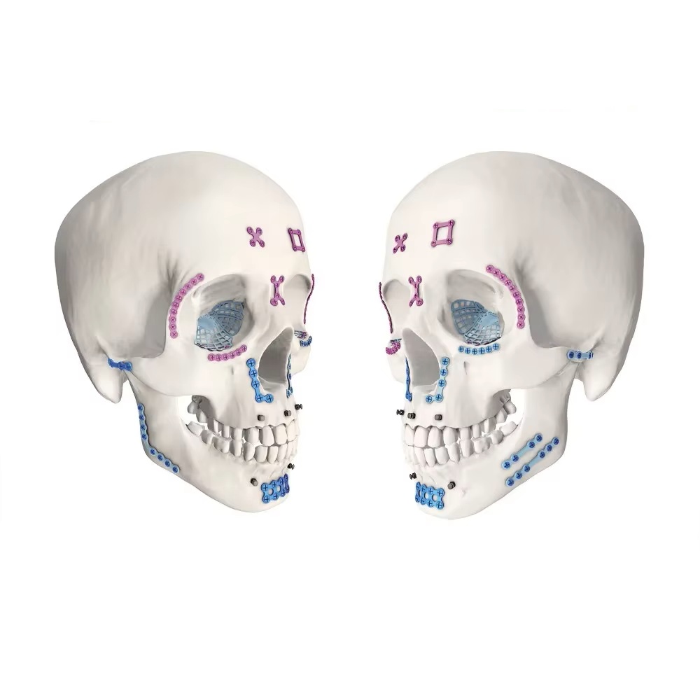 KangerMedical's tweet image. Placas óseas de titanio puro ZAPP de Kanger Medical: alta biocompatibilidad, orificio cóncavo para mejor fijación y bordes suaves que reducen molestias del tejido blando. Solución práctica para CMF.
📩 crystal@kangeryl.com#titaniumplates #cmf #maxillofacial #bonefixation