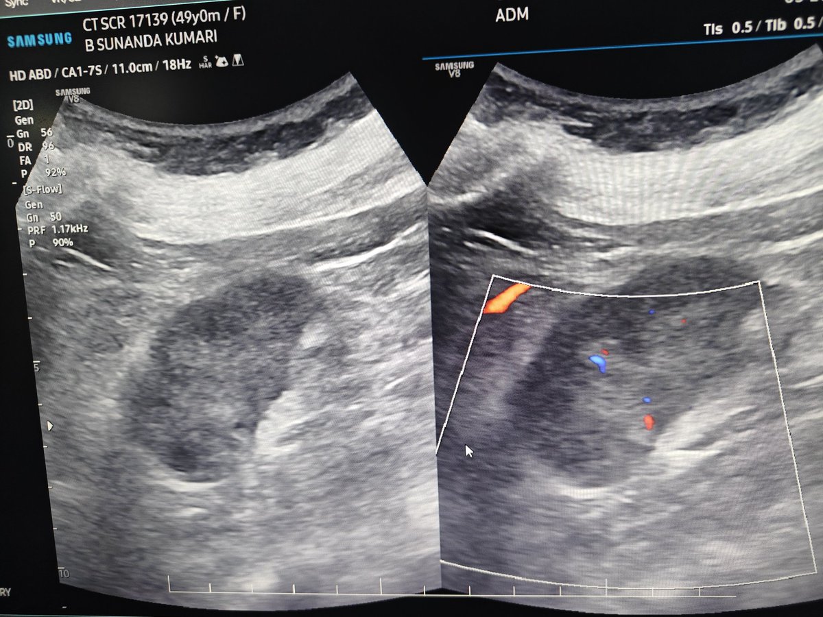madiyfea's tweet photo. Incidentally detected solid isoechoic lesion in kidney https://t.co/4tUQAFrEQ7