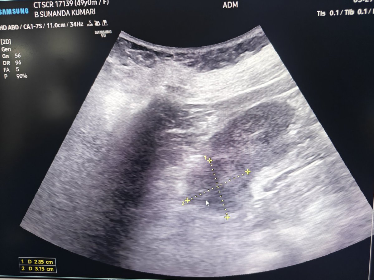 madiyfea's tweet photo. Usual asymptomatic patient,incidentally detected renal mass https://t.co/6Btxf9sqDj