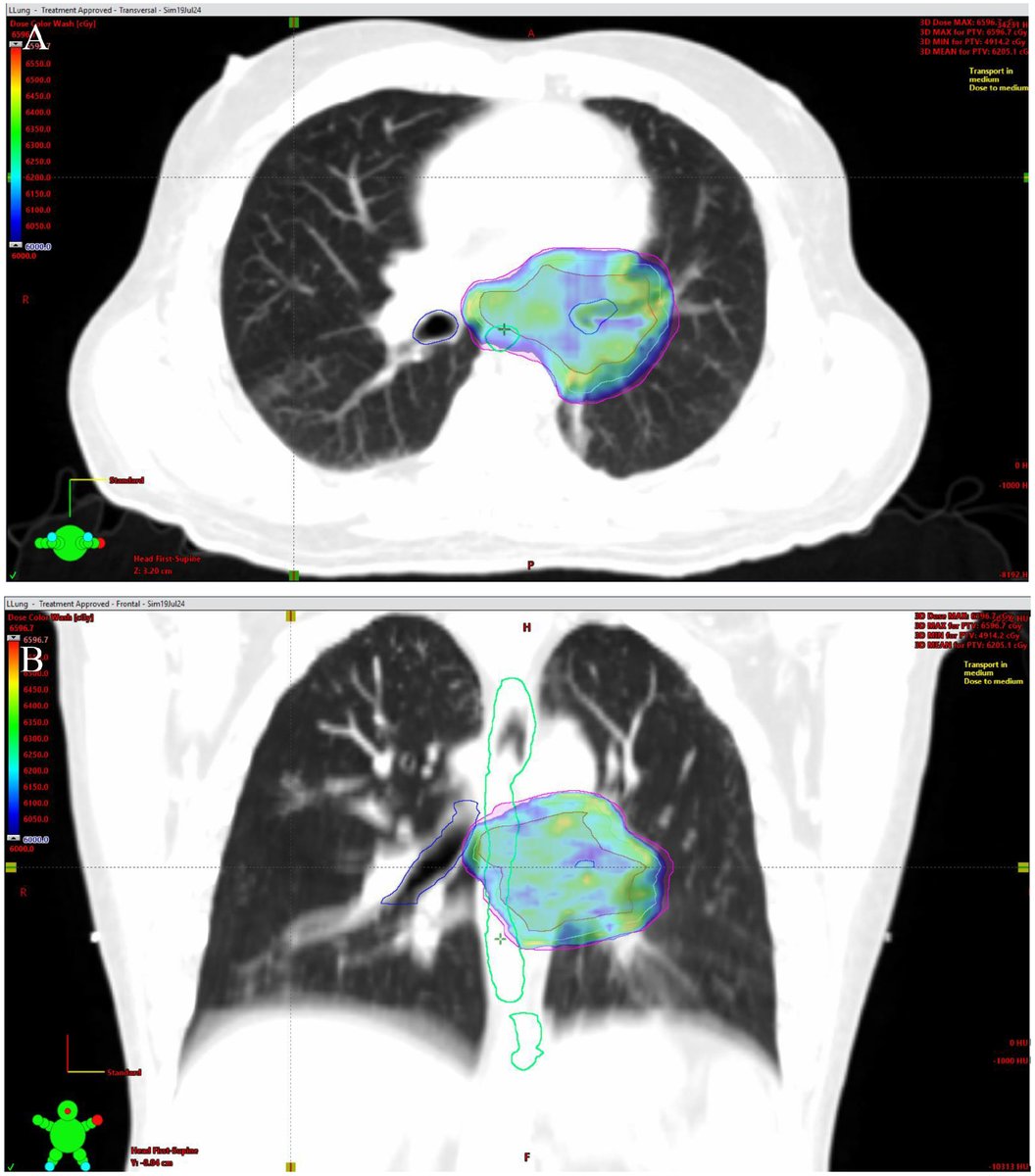 New in #practicalRO: A Case for Caution in a New Era of Managing Patients with Locally Advanced Non-Small Cell Lung Cancer: Fatal Bronchial-Esophageal Fistula After Neoadjuvant Chemo-Immunotherapy Followed by Definitive Chemoradiation Therapy. tinyurl.com/heintzelman1
