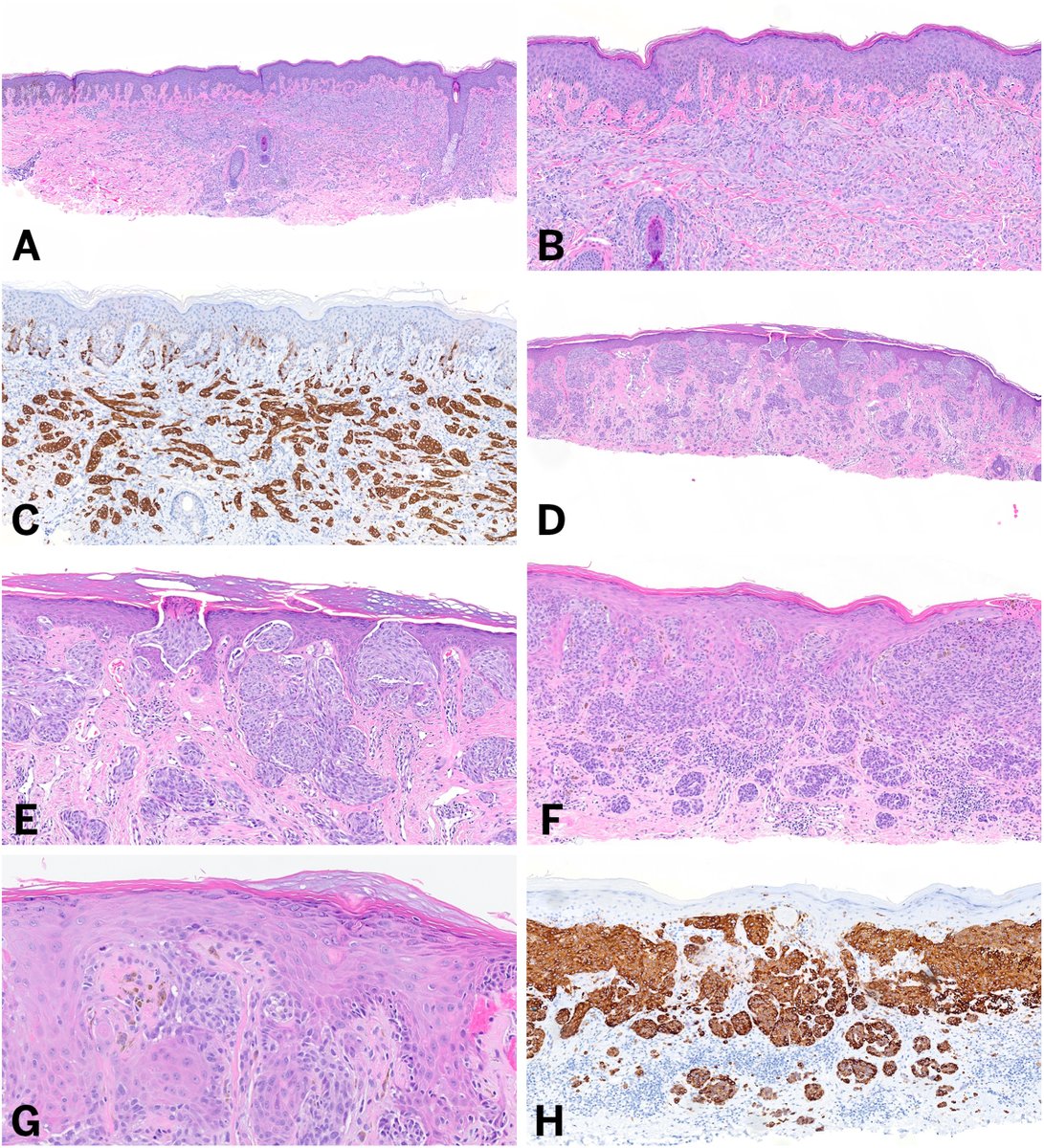 Human_Pathology's tweet photo. New in #HumPathol: Every Day a New Fusion? – An Update on Recent Discoveries in Dermatopathology. https://t.co/GMXkRKISWX #pathology #PathTwitter #PathX #dermpath https://t.co/SO19clsYS0