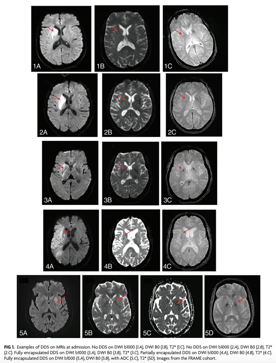 TheAJNR's tweet photo. "Dark Diffusion Sign: A Novel MRI Predictor of Hemorrhagic Transformation in Patients with Stroke Treated with Endovascular Therapy?"

https://t.co/mRMc4vaK63 https://t.co/dS65G8PE9h