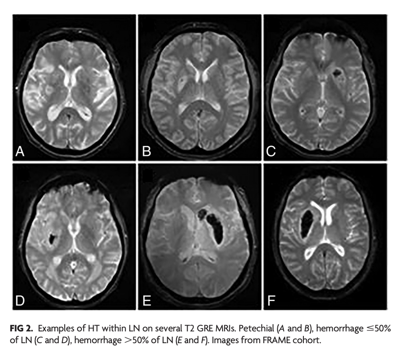 TheAJNR's tweet photo. "Dark Diffusion Sign: A Novel MRI Predictor of Hemorrhagic Transformation in Patients with Stroke Treated with Endovascular Therapy?"

https://t.co/mRMc4vaK63 https://t.co/dS65G8PE9h