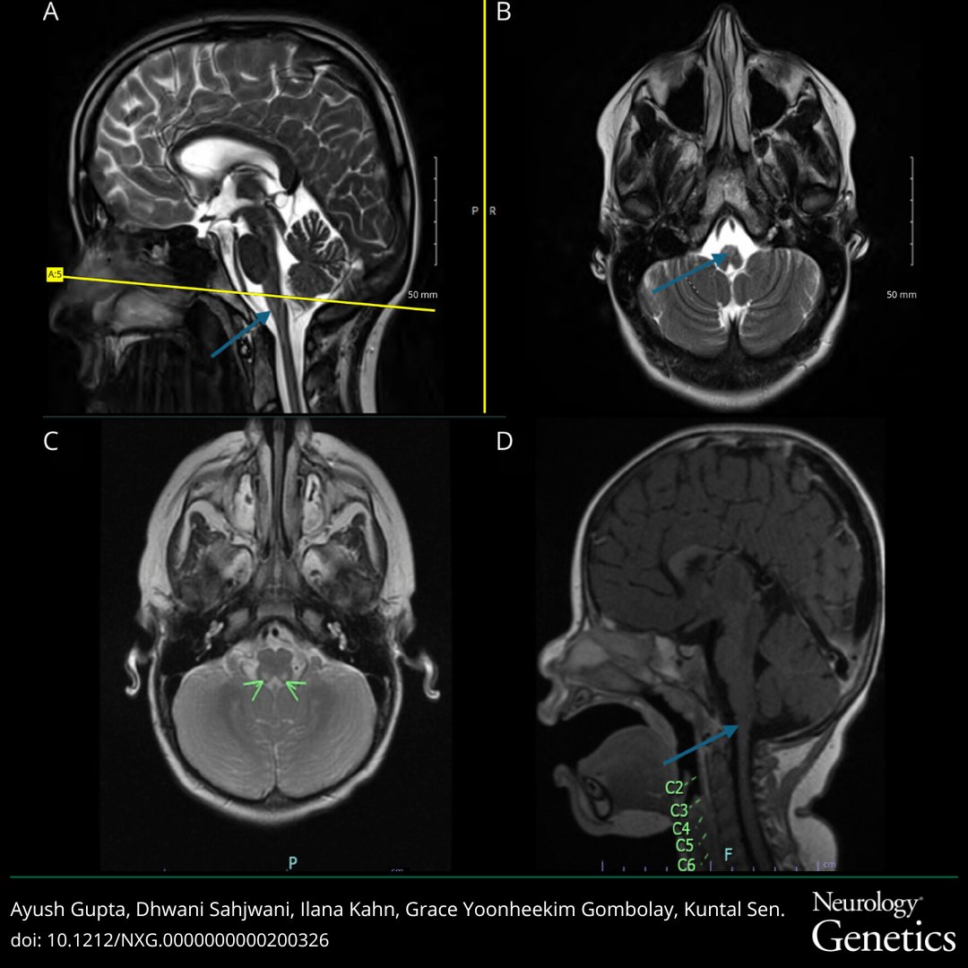 GreenJournal's tweet photo. This review examines some of the monogenic disorders that can masquerade as neuroinflammatory phenotypes: https://t.co/4ScGwxq6lJ 

#NeuroTwitter #NeuroX https://t.co/5czEvZ0z1X