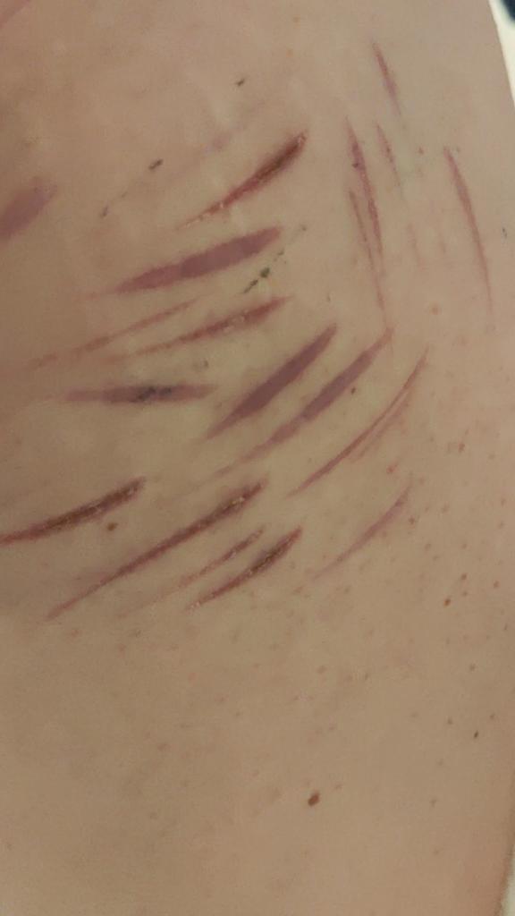 PinkunoL's tweet photo. I feel like such an attention seeker because its not even that bad.. https://t.co/HpGpF5q58l