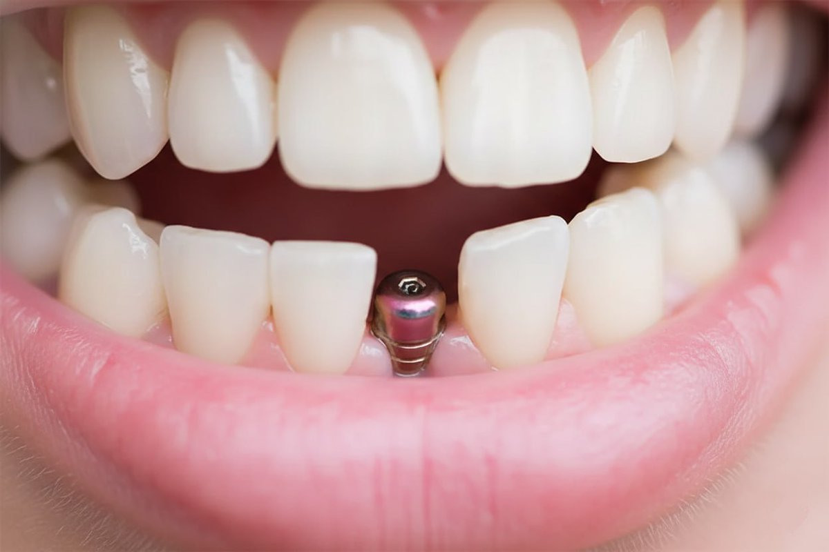 gundemedairhs's tweet image. MHP, implant tedavisinin SSK tarafından karşılanmasına yönelik kanun teklifini Meclis’e sundu. 

Yerli üretim ve en fazla 4 implant şartıyla tüm vatandaşların tedavi masrafları devlet tarafından karşılanacak.