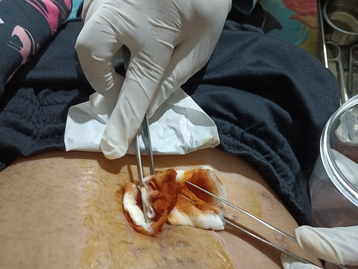 Jahitan pasca operasi usus buntu sudah dilepas, semoga segera kering luar dan dalamnya. Terimakasih doa teman² sehingga aku segera pulih seperti sedia kala. 🙏