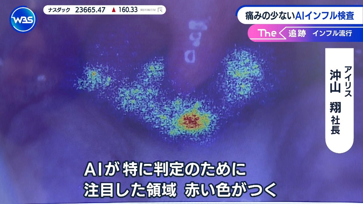 傷みの少ないAIインフルエンザ検査 AI医療機器「nodoca」 #WBS