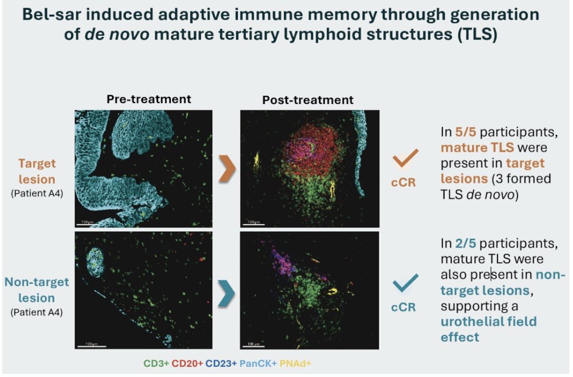 urotoday's tweet photo. #TrialsinProgress: Safety and efficacy of belzupacap sarotalocan (AU-011), a virus-like drug conjugate, in participants with nonmuscle-invasive #BladderCancer. Presentation by @MaxKates @HopkinsMedicine. #SUO25 written coverage by @RKSayyid @UAUrology > https://t.co/MokEv1wx3I @UroOnc