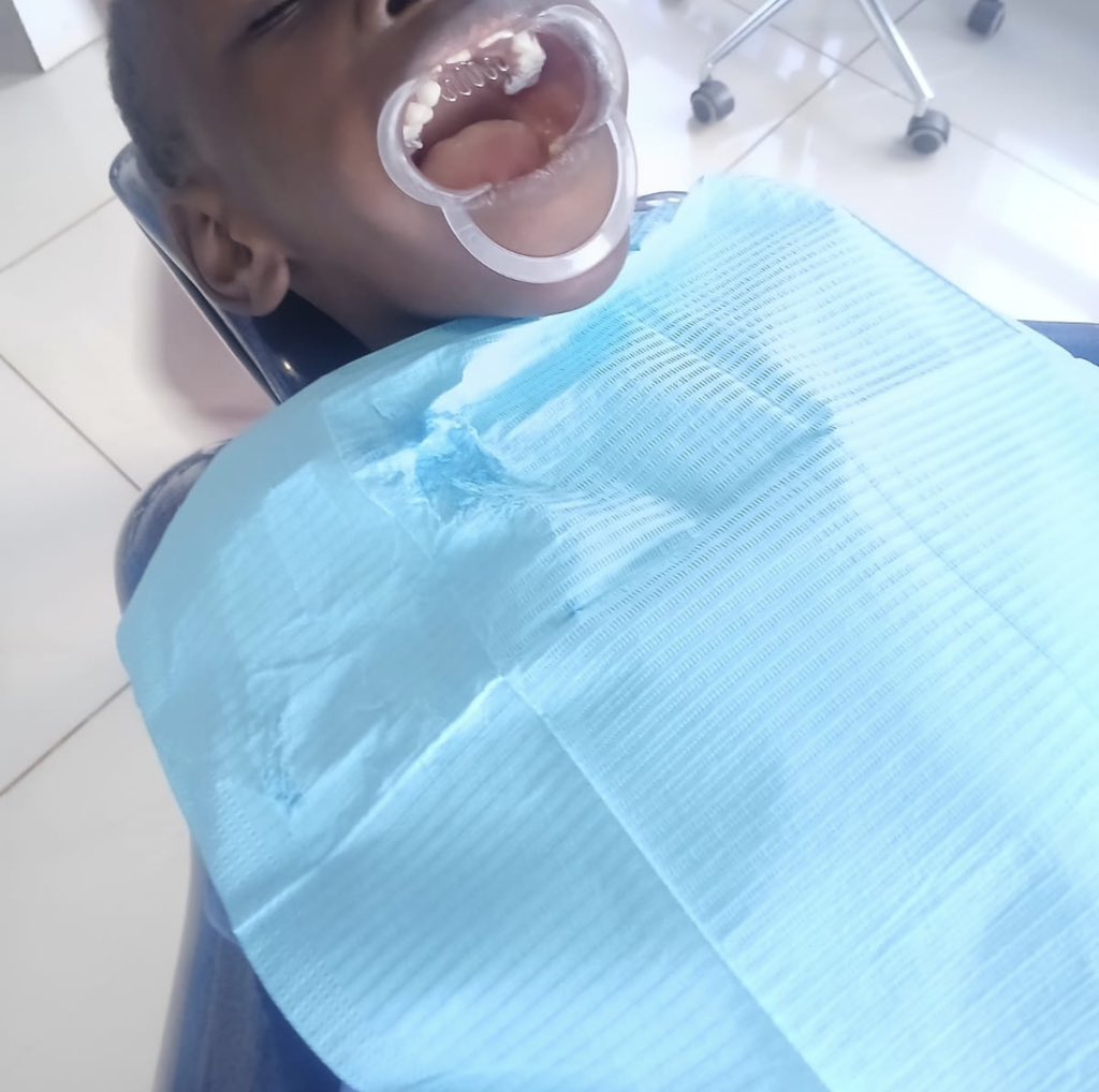 Polo OCHIENG ODONGO got his HABIT BREAKER device installed; this device is basically used to help break oral habits like thumb sucking and tongue thrusting which affected his tooth alignment and speech 🎤 

Barikiwa sana Dr. <a href="/Branicemercy/">Dr Branice Munyasa</a> and <a href="/NEXTCAREDENTAL/">NEXTCAREDENTALSTUDIO</a> team

This is