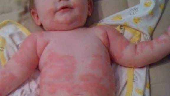 التأخر في إدخال مسببات الحساسية لغذاء الطفل ( كالفول السوداني و البيض والقمح وغيرها ..) يزيد من احتمالية إصابة الطفل بحساسية الطعام بل وبالربو وغيره من أنواع الحساسية…
لذلك تنصح معظم الأكاديميات الطبية المعتمدة بإدخال هذه المسببات لغذاء الطفل من عمر 6 شهور…
من لديه حساسية أو