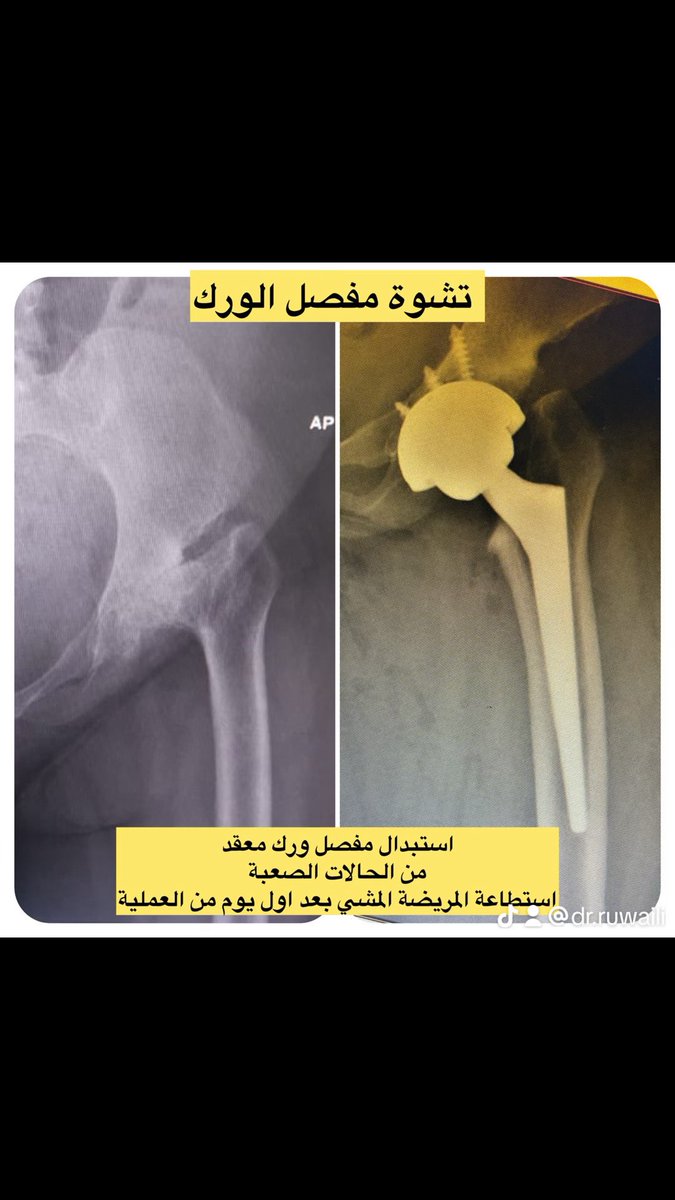 dr_ruwaili's tweet photo. تشوّه متقدم واحتكاك في مفصل الورك:
في بعض الحالات المتقدمة يكون العلاج الأمثل هو استبدال مفصل الورك بالكامل.

بفضل الله ثم وجود التقنيات الحديثة يمكن للمريض البدء بالمشي ابتداءً من اليوم الأول بعد العملية وتحسن كبير في الألم والحركة خلال فترة قصيرة.

🔹 هدف العملية: ازالة الألم، تحسين الحركة، واستعادة جودة الحياة 
#استبدال_مفصل_الورك