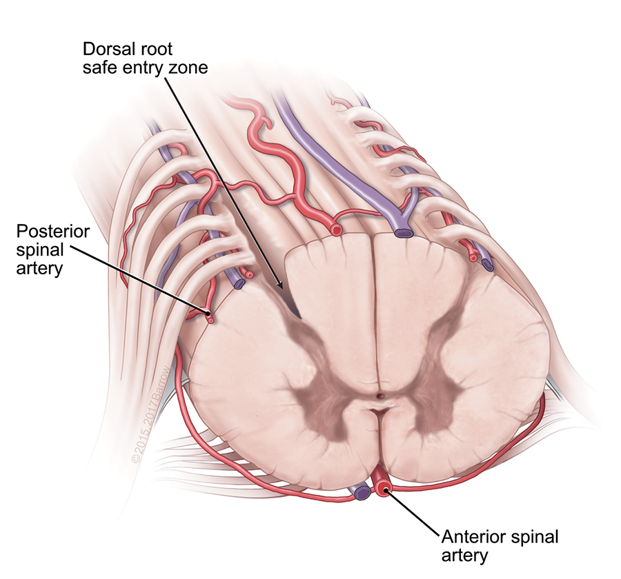 mtlawton's tweet photo. Watch this Seven Series video showing this C1-C3 laminectomy, resection of multicentric spinal cord cavernous malformation thru midline and dorsal root entry zone myelotomies, on our website @BarrowNeuro by clicking on this link… https://t.co/J7JSfScET4. https://t.co/UB94MIDLiP