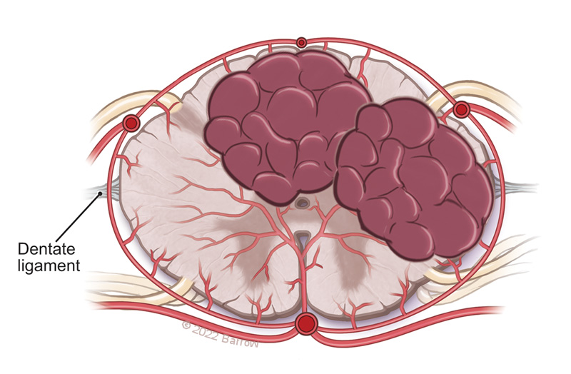 mtlawton's tweet photo. Watch this Seven Series video showing this C1-C3 laminectomy, resection of multicentric spinal cord cavernous malformation thru midline and dorsal root entry zone myelotomies, on our website @BarrowNeuro by clicking on this link… https://t.co/J7JSfScET4. https://t.co/UB94MIDLiP