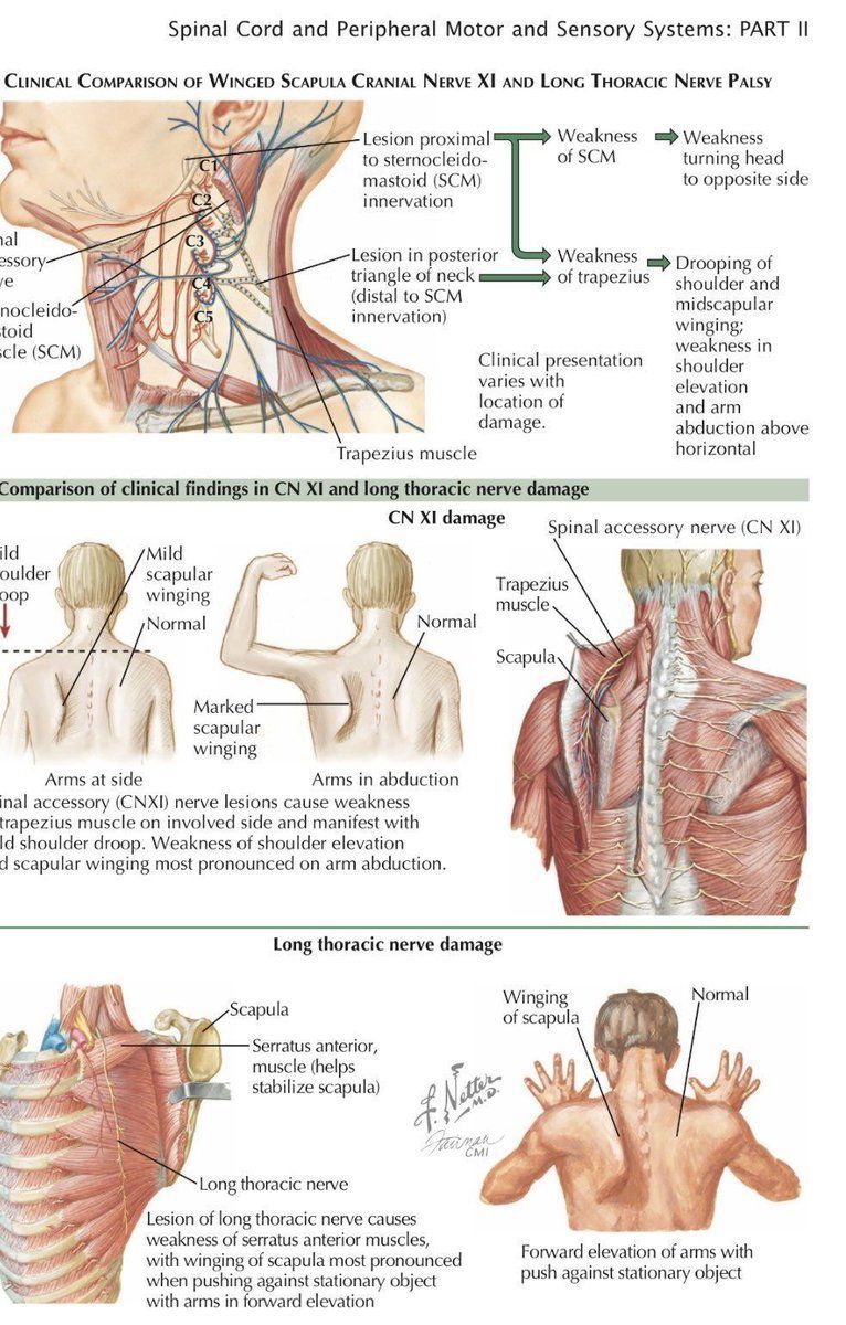 Winging Scapula