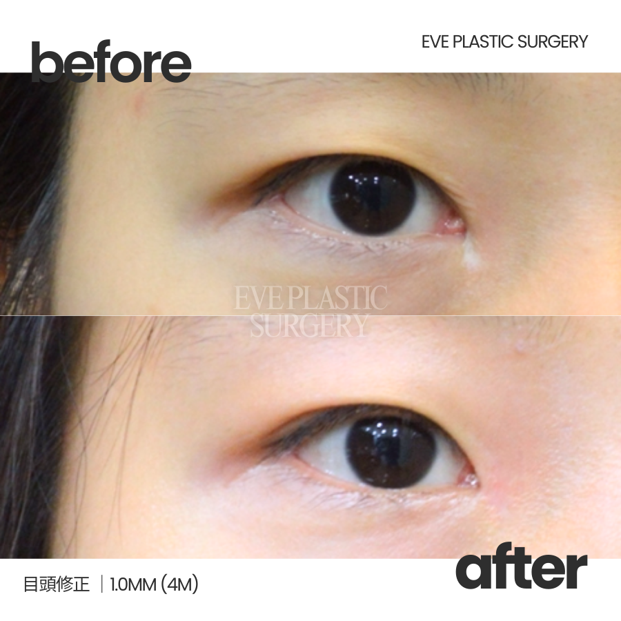 EvePlastic's tweet photo. 【目頭修正｜術後4ヶ月の経過🌿】
目頭切開後に生じたシワのように見える横の傷跡を改善し、
詰まって見える目頭の形を自然なラインへ修正しました。

当院は、目元の再手術・傷跡修正に特化した
イブ韓国整形外科です👨‍⚕️
20年間の修正経験をもとに、皆さまのお悩みに寄り添いながら解決へ導きます☺️

📌写真カウンセリングにて、
当日の手術枠のご予約も可能です！
📷 https://t.co/qb3YISiTw9

#イブ整形外科 #目頭修正 #目頭切開傷跡 #目頭切開修正 #傷跡修正 #目頭切開失敗 #目元整形トラブル修正 #目元整形 #涙丘露出 #整形修正 #整形失敗修正 #自然な目元 #韓国美容整形 #渡韓整形サポート #無料カウンセリング #目元コンプレックス #目元の悩み #整形再手術 #目元美人 #二重整形 #ナチュラル目元 #美容整形 #韓国整形 #目元形成 #目頭切開