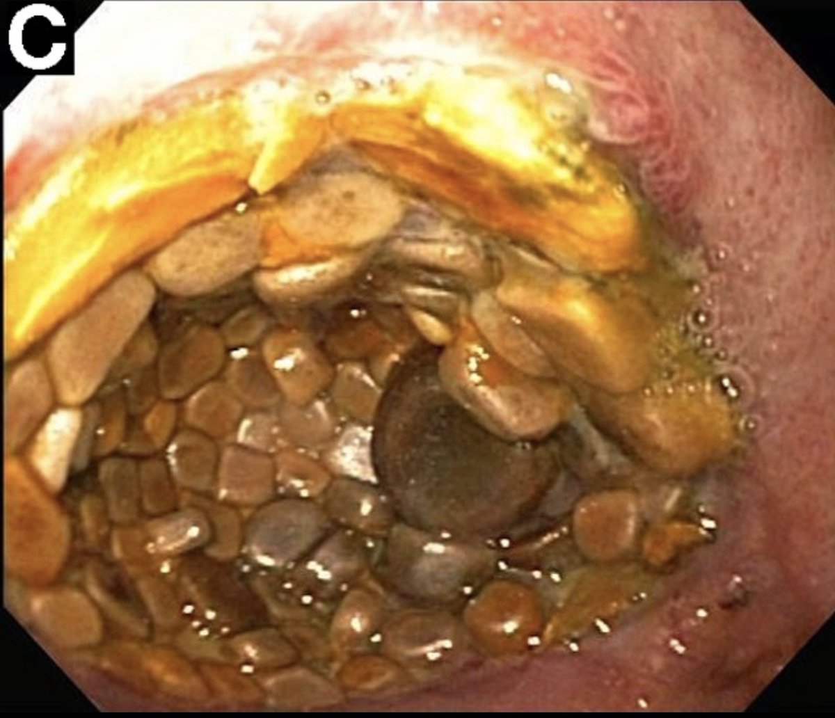 Seen on endoscopy in the duodenum. What’s going on here?