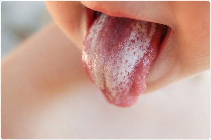 Ever opened your mouth and saw white patches that looked like “akamu” or thick milk on your tongue or cheeks — and no matter how you scrape, it comes back?

That might not be leftover food o…

It could be oral thrush.

Let’s break it down 👇

DEFINITION

Oral thrush is a fungal