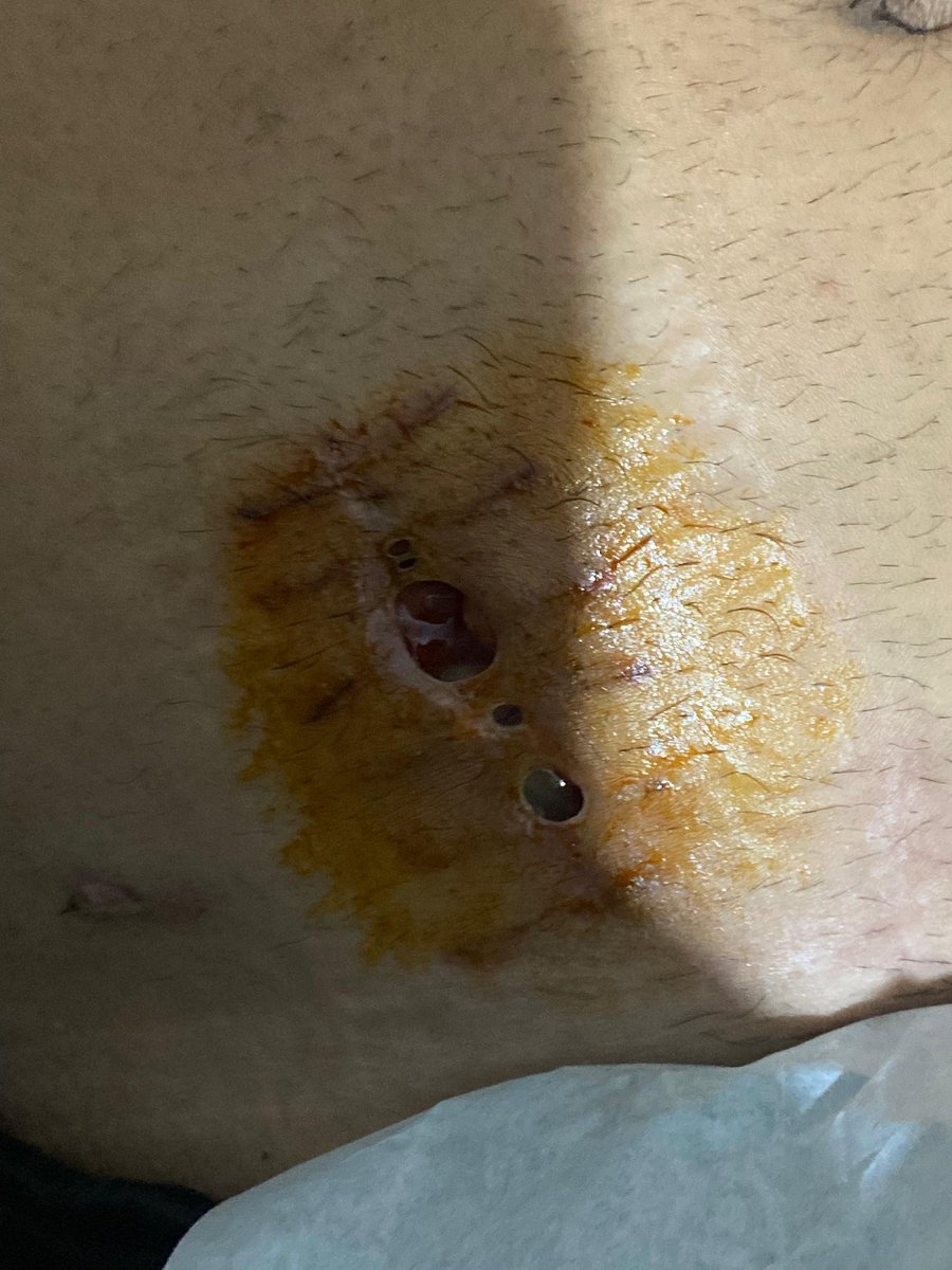 Kenapa jadi bolong gini pasca jahitannya di lepas ?