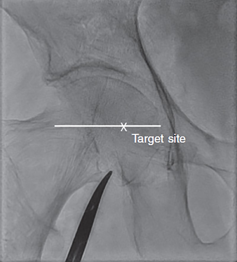 Ideal Femoral Access Site

●Femoral arterial anatomy with the ideal target site of arteriotomy being above the bifurcation and below the inferior epigastric artery on the femoral head.

●Common femoral artery (CFA) is the best puncture site because of its larger size and