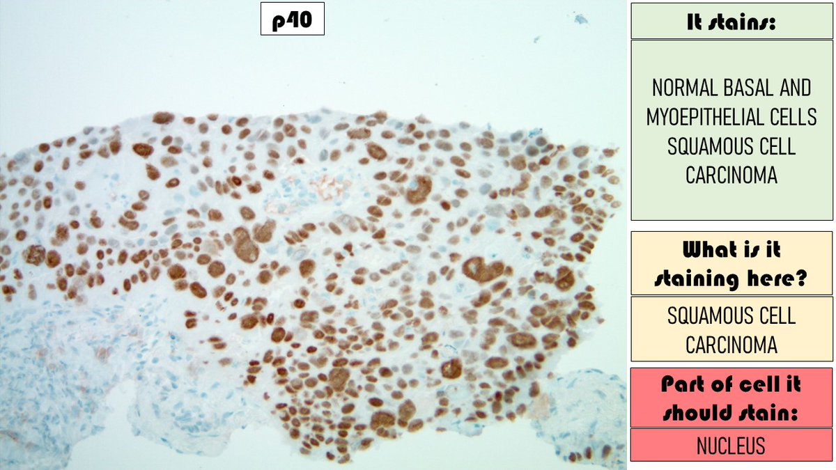 Immunohistochemistry flashcard series. Part 6: p40  

Full YouTube video: youtube.com/watch?v=s5XbGh…     

Learn more at our upcoming surgical pathology conference in Las Vegas, register here: clevelandclinicmeded.com/live/courses/p…