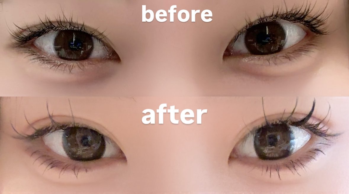 R beauty clinicのりぃ先生に埋没してもらって1ヶ月経ったよ❕初日から腫れてなかったけど、全ての腫れが無事引いて綺麗な二重になりました✌🏻アイシャドウも映えるしマツエクもカラコンも超楽しくなって最高。元々左右左のある目なんだけど、埋没で無事コンプ解消されたからオススメ❕PR