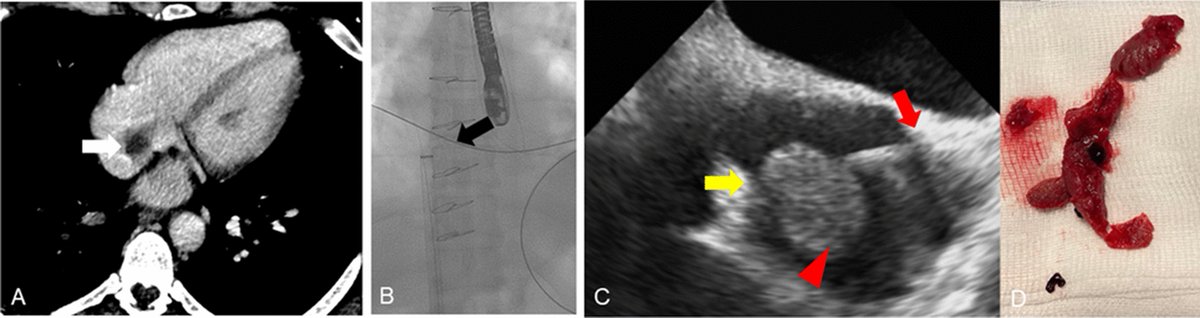 CVIR_Journal's tweet image. #LettertoEditor 📬
Endovascular Thrombectomy of Right Atrial Thrombus in Heart Transplant Recipients
link.springer.com/article/10.100…