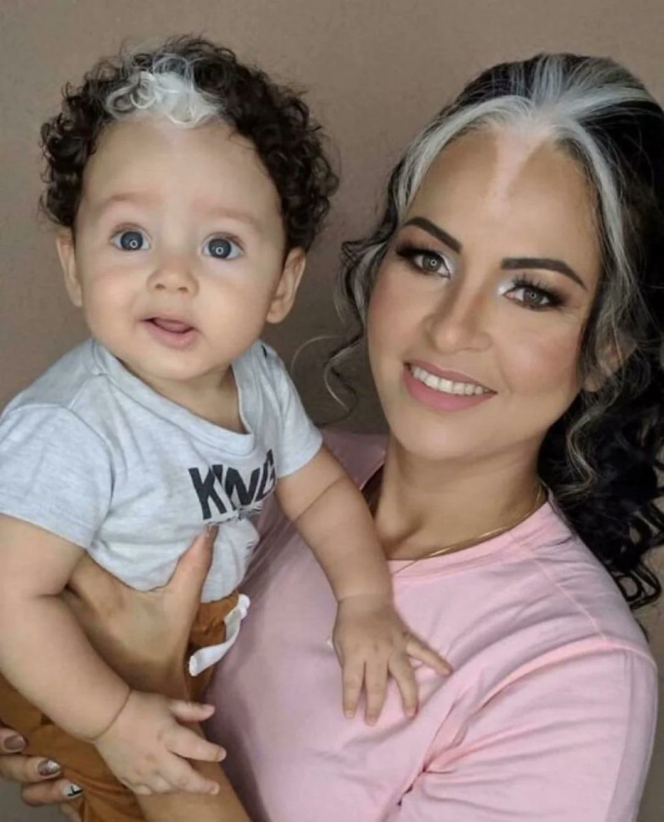 redditrepost_'s tweet photo. Mother and child with poliosis, a hereditary white streak in their hair https://t.co/l4ohspando