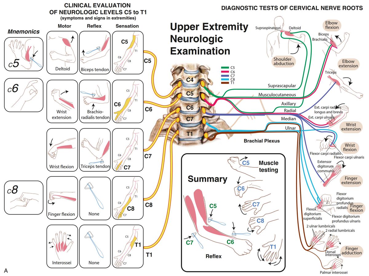 Just published 🔥

𝗡𝗲𝘂𝗿𝗼𝗹𝗼𝗴𝗶𝗰𝗮𝗹 𝗘𝘅𝗮𝗺𝗶𝗻𝗮𝘁𝗶𝗼𝗻 𝗳𝗼𝗿 𝗖𝗲𝗿𝘃𝗶𝗰𝗮𝗹 𝗥𝗮𝗱𝗶𝗰𝘂𝗹𝗼𝗽𝗮𝘁𝗵𝘆: 𝗔 𝗦𝗰𝗼𝗽𝗶𝗻𝗴

pubmed.ncbi.nlm.nih.gov/40188056/

☑️𝗯𝗲𝘀𝘁 𝘂𝘀𝗲𝗱 𝘁𝗼 𝗿𝘂𝗹𝗲 𝗶𝗻 𝗿𝗮𝘁𝗵𝗲𝗿 𝘁𝗵𝗮𝗻 𝘁𝗼 𝗿𝘂𝗹𝗲 𝗼𝘂𝘁!

📷shop.elsevier.com/books/millers-…