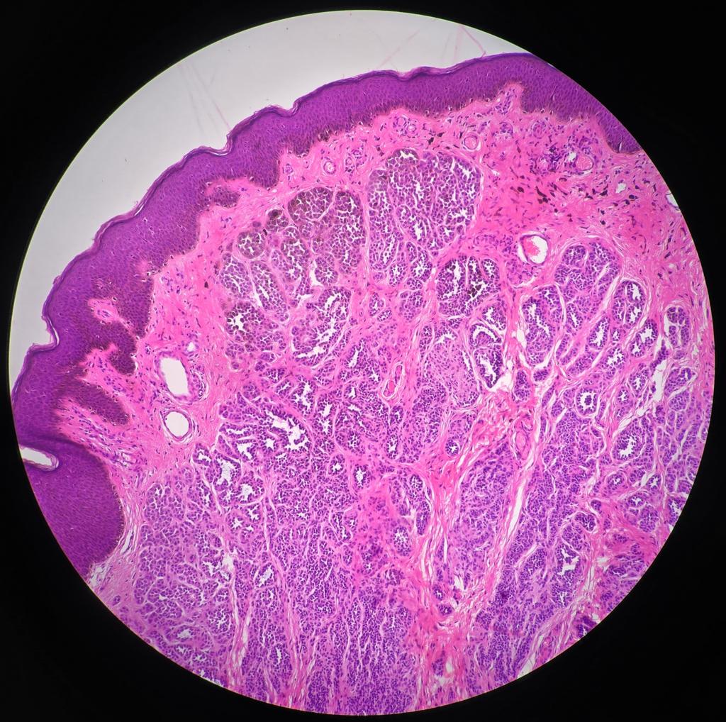 SyedSal55391459's tweet photo. #histopathology
#nevus
#pathX
#pathTwitter
#photomicrograph
Dx: Intradermal nevus. https://t.co/0yjnwV0LFY