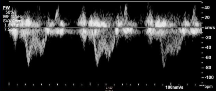 ross_prager's tweet image. Previously healthy patient with acute shortness of breath. This one Doppler measurement gives the diagnosis. 

What's going on? 👇