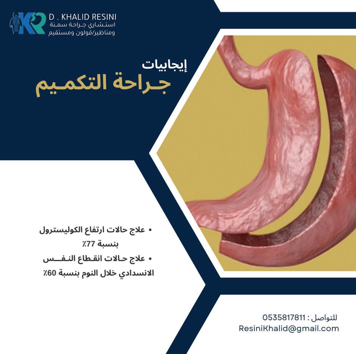 إيجابيات إجراء جراحة التكمـيم