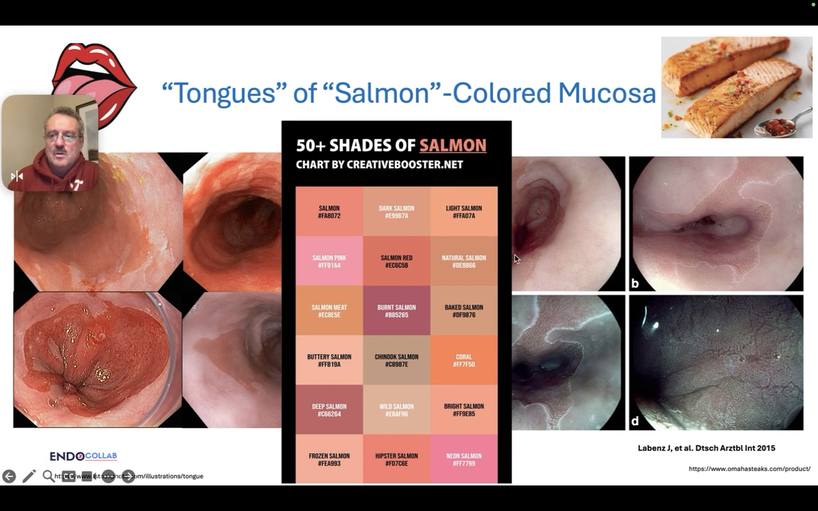 EndoCollabcom's tweet photo. Missed Barrett’s neoplasia is a critical issue in endoscopy.

Master the "50 Shades of Salmon," the importance of palisade vessels, and the "Barrett Archipelago" concept in this comprehensive State-of-the-Art lecture by Dr Mönkemüller

Watch on EndoCollab: https://t.co/lw4usj43xI https://t.co/e4TUvMBIwp