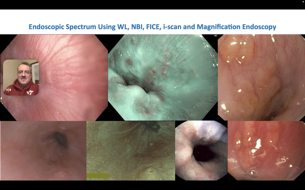 EndoCollabcom's tweet photo. Missed Barrett’s neoplasia is a critical issue in endoscopy.

Master the "50 Shades of Salmon," the importance of palisade vessels, and the "Barrett Archipelago" concept in this comprehensive State-of-the-Art lecture by Dr Mönkemüller

Watch on EndoCollab: https://t.co/lw4usj43xI https://t.co/e4TUvMBIwp