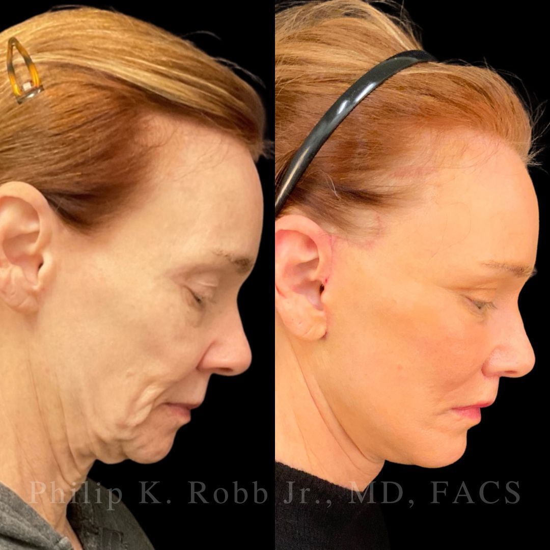 RobbJrMD's tweet image. Lisbeth did her homework… for OVER 2 years 🤯

‼️The best part? She’s only 25% healed — results will keep refining for months.

What grabs your eye first: her neck or her eyes??👀