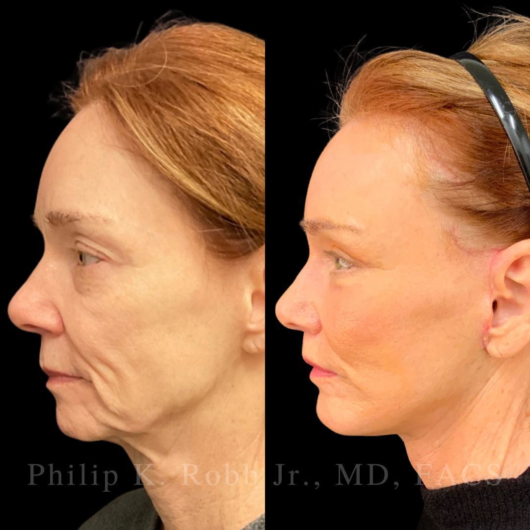 RobbJrMD's tweet image. Lisbeth did her homework… for OVER 2 years 🤯

‼️The best part? She’s only 25% healed — results will keep refining for months.

What grabs your eye first: her neck or her eyes??👀