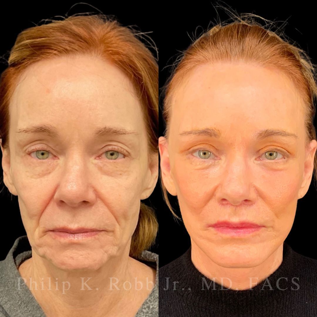 RobbJrMD's tweet image. Lisbeth did her homework… for OVER 2 years 🤯

‼️The best part? She’s only 25% healed — results will keep refining for months.

What grabs your eye first: her neck or her eyes??👀