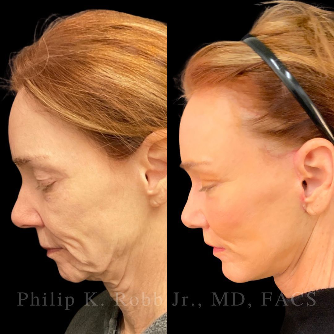 RobbJrMD's tweet image. Lisbeth did her homework… for OVER 2 years 🤯

‼️The best part? She’s only 25% healed — results will keep refining for months.

What grabs your eye first: her neck or her eyes??👀